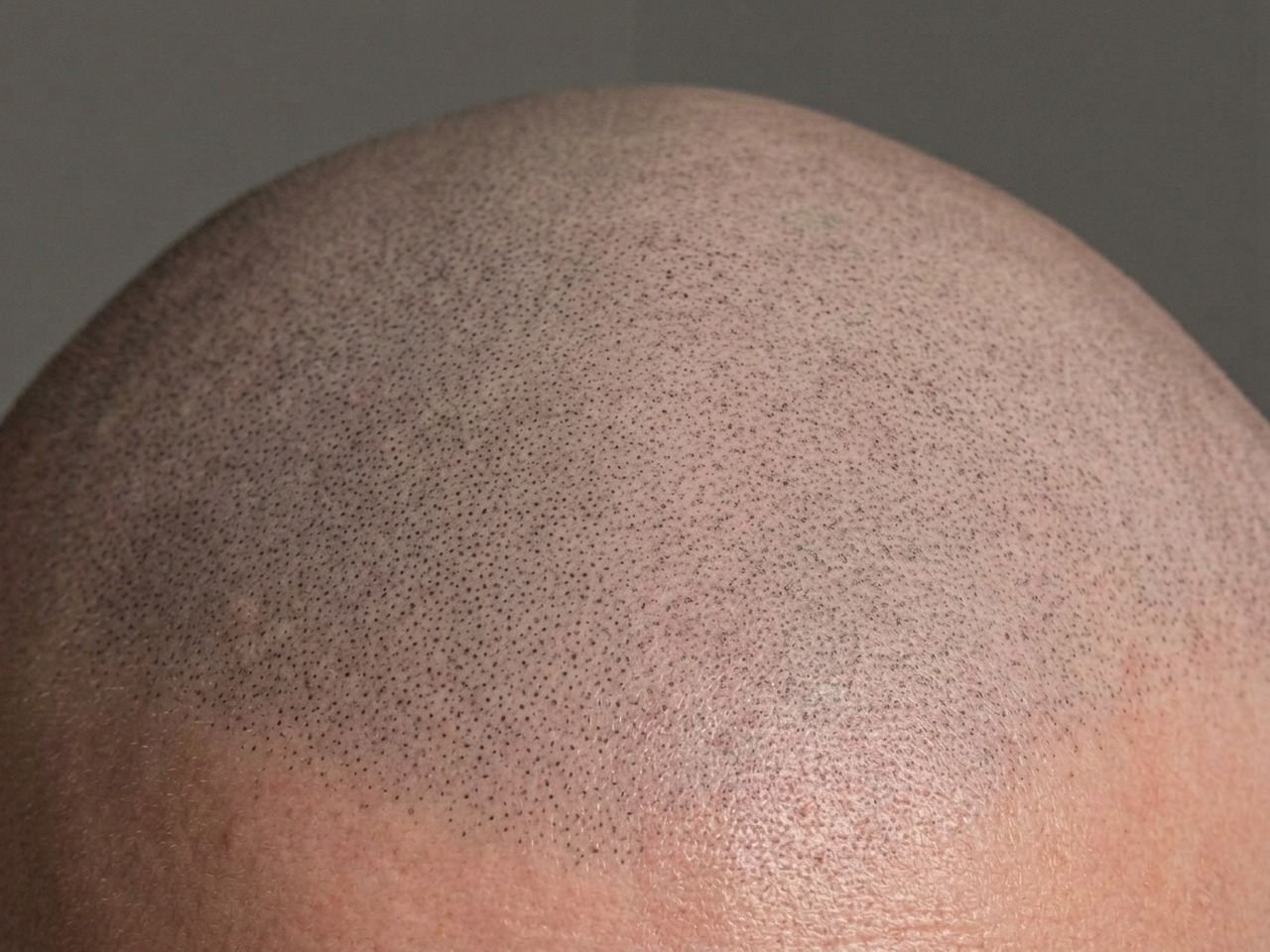 Hairline Restoration