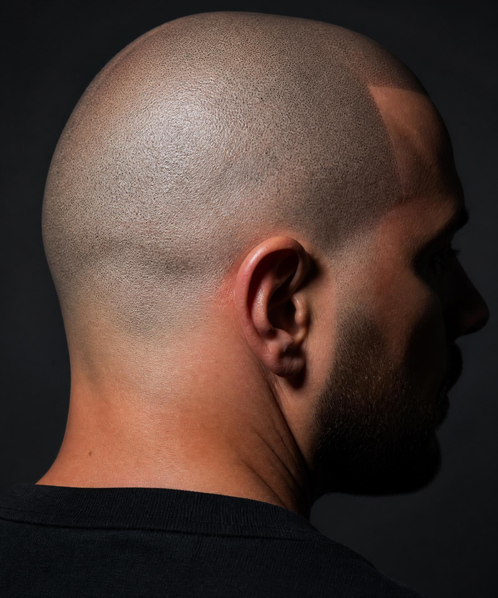 Close-up of a scalp micropigmentation hairline treated at VOID SMP